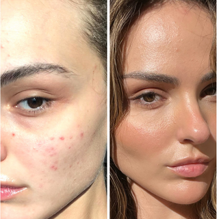 Clear Skin Formula Acne Nutraceutical + Probiotics Bundle