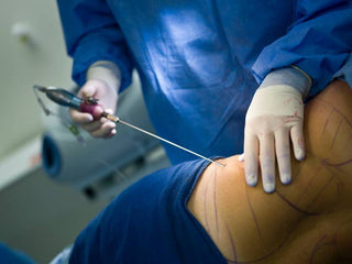 Exercise Prevents Weight Gain After Liposuction