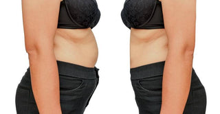 Liposuction and Body Mass Index